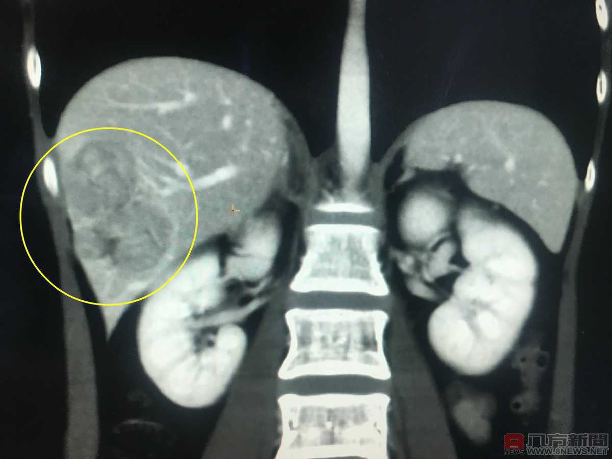 為解血光之災就醫 24歲女意外查出肝癌