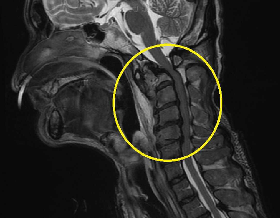 腫瘤壓迫頸椎神經 下咽癌病人突然癱瘓