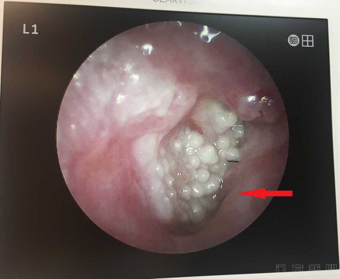 右耳突然聽不到 就醫驚見耳朵長滿菜花