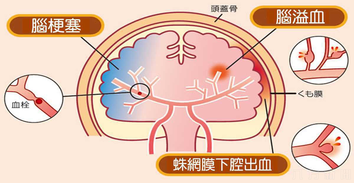 年輕並非本錢 不避開危險因子 當心腦中風年輕化
