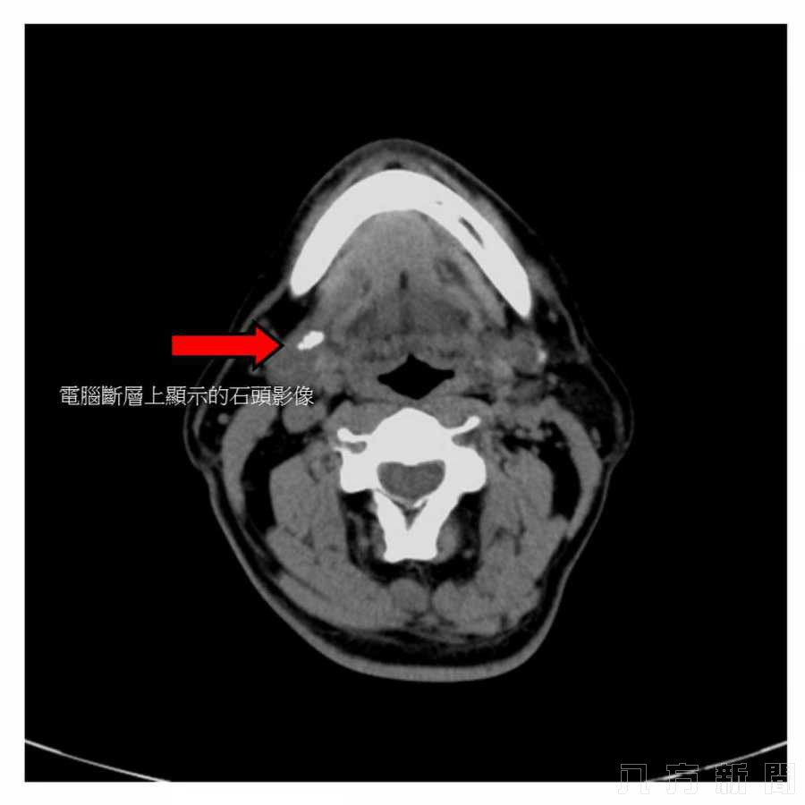 脖子疼痛竟是結石惹的禍