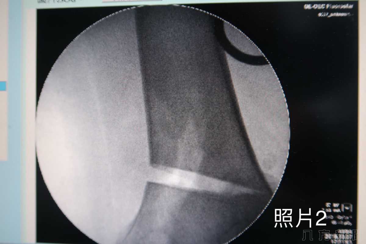 別以為年輕就是本錢，壯男體重過重提早壓壞膝關節