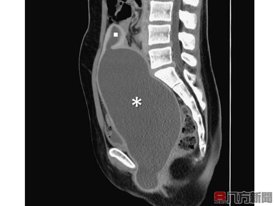 14歲少女尿不出來 竟是處女膜閉鎖導致
