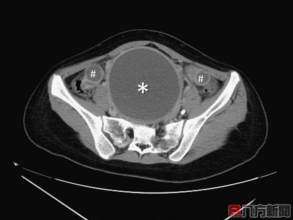 14歲少女尿不出來 竟是處女膜閉鎖導致