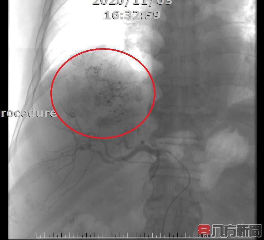 肝臟長腫瘤 醫：治療多別輕易放棄