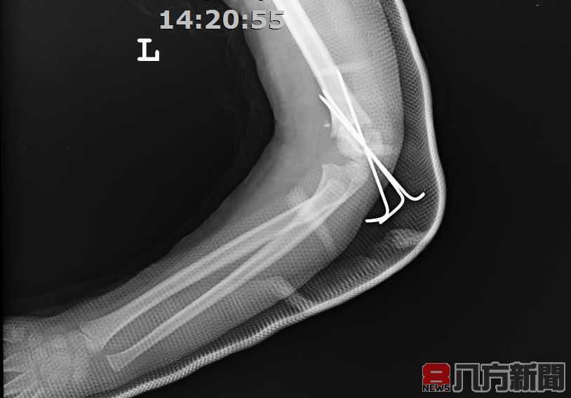 兒童常見意外 騎腳踏車跌倒手肘變形骨折
