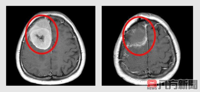 罹腦瘤嚴重影響神經功能 緊急開顱「拆彈」救命