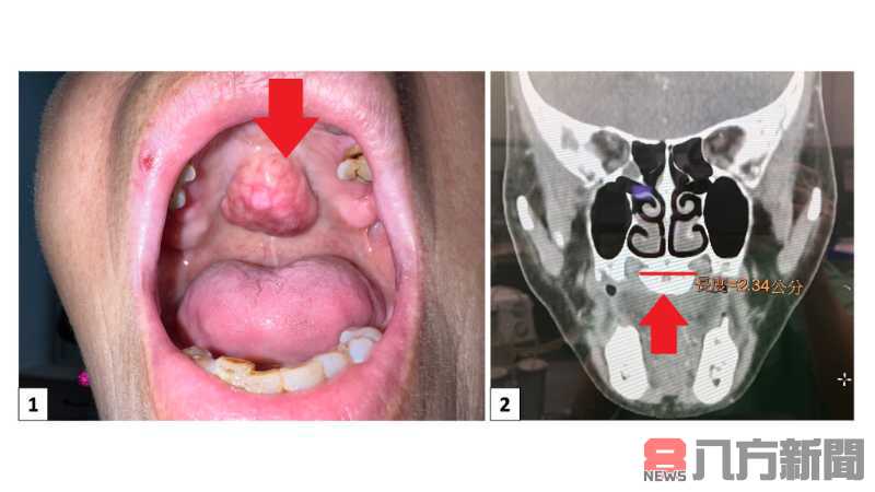 口腔不明硬塊影響進食 手術治療重拾美味人生