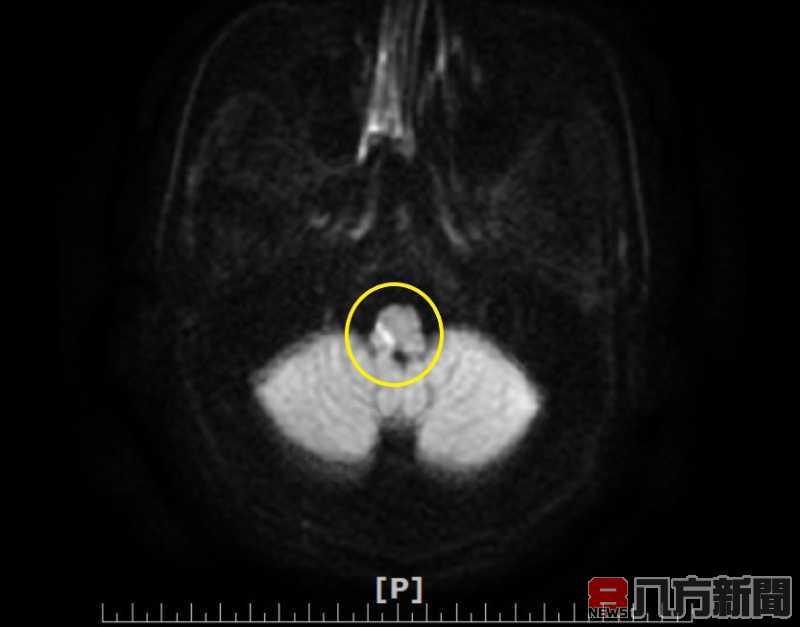 洗澡突感受不出水溫冷熱 就醫竟是腦幹中風