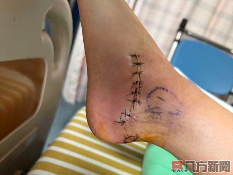 少女騎車自摔左腳粉碎性骨折 仁愛長庚醫療團隊聯手重建