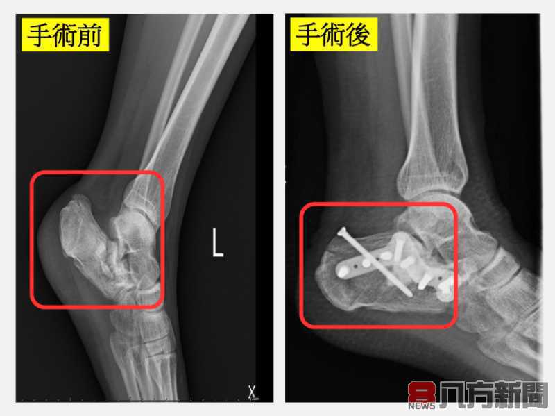 少女騎車自摔左腳粉碎性骨折 仁愛長庚醫療團隊聯手重建