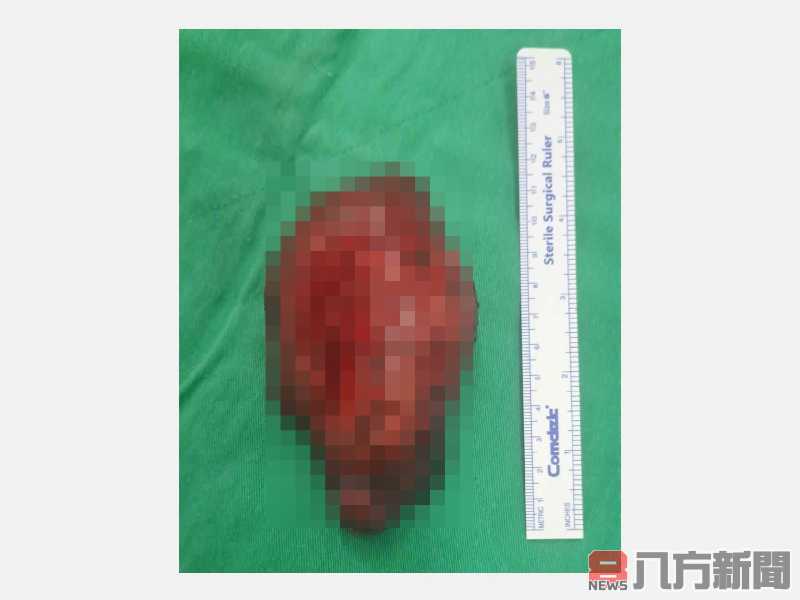 總算放下胸中的大石了 甲狀腺也會引起胸悶