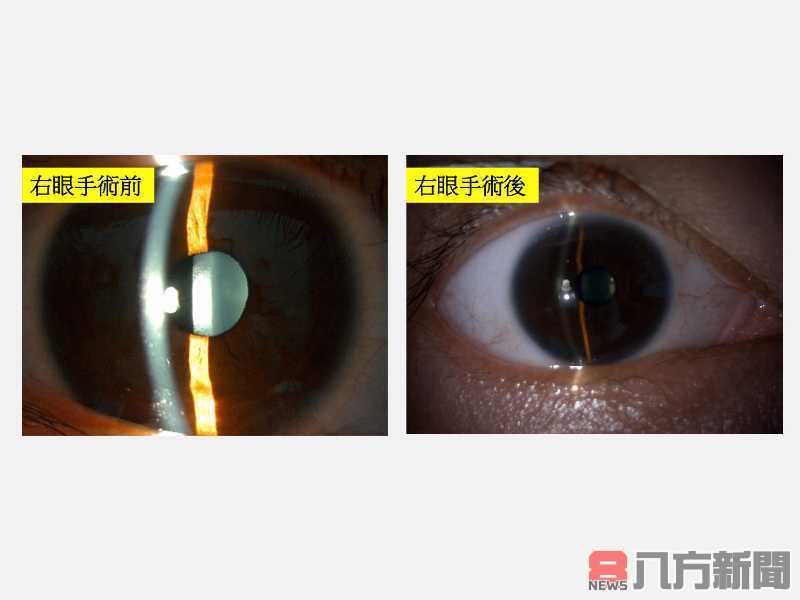 戴眼鏡不便隱形眼鏡又怕受傷 全飛秒近視雷射帶來清晰世界