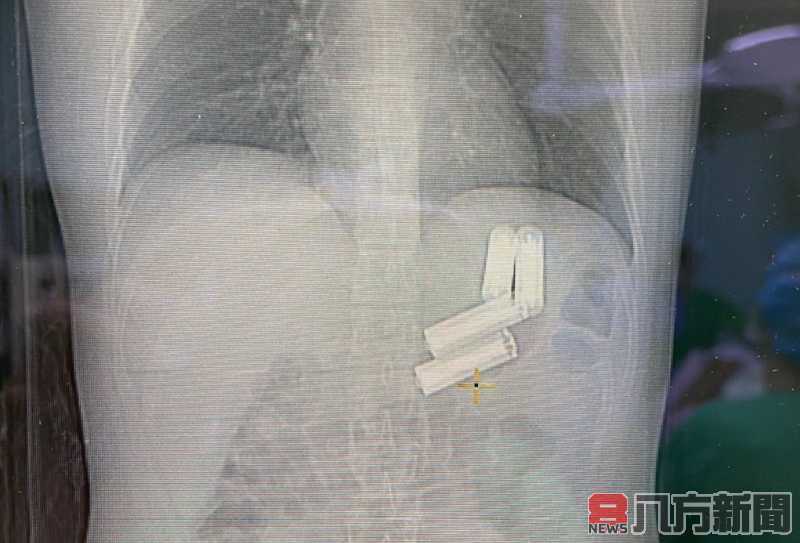 男噁心嘔吐以為消化不良 醫師從胃中取出矽膠手套