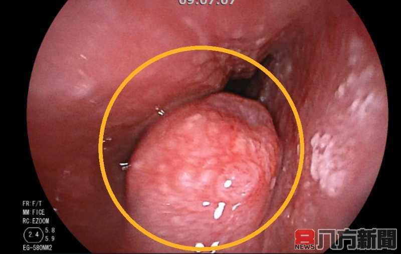 不菸不酒竟罹食道癌 南投醫院用大腸重建手術成功治療