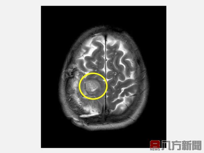 清醒開顱手術在仁愛長庚 安全迅速切除惡性腫瘤