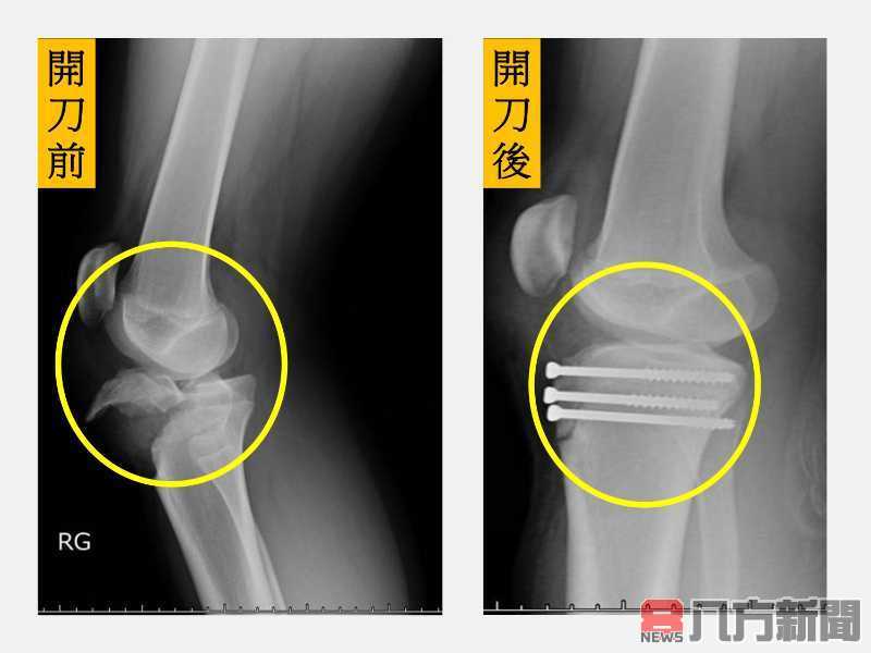 右膝近端脛骨骨折合併生長板受損 復位固定手術助復原