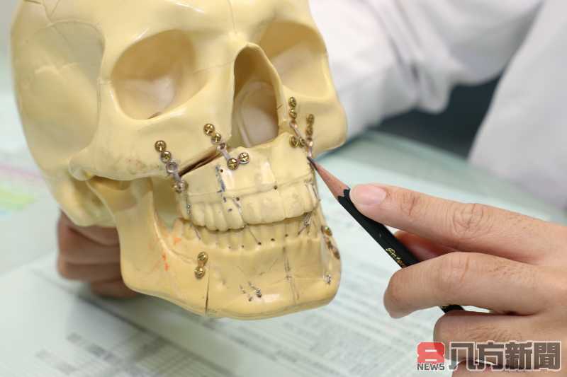 車禍後顏面骨重創 正顎手術恢復咬合功能與自信容貌