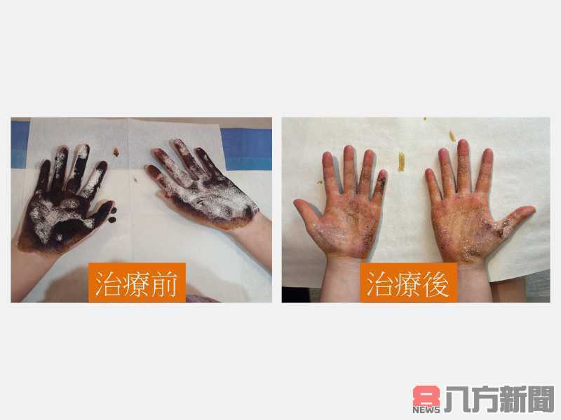 青春期少女深受手汗與腋下異味困擾 清新門診助她揮別尷尬重拾自信