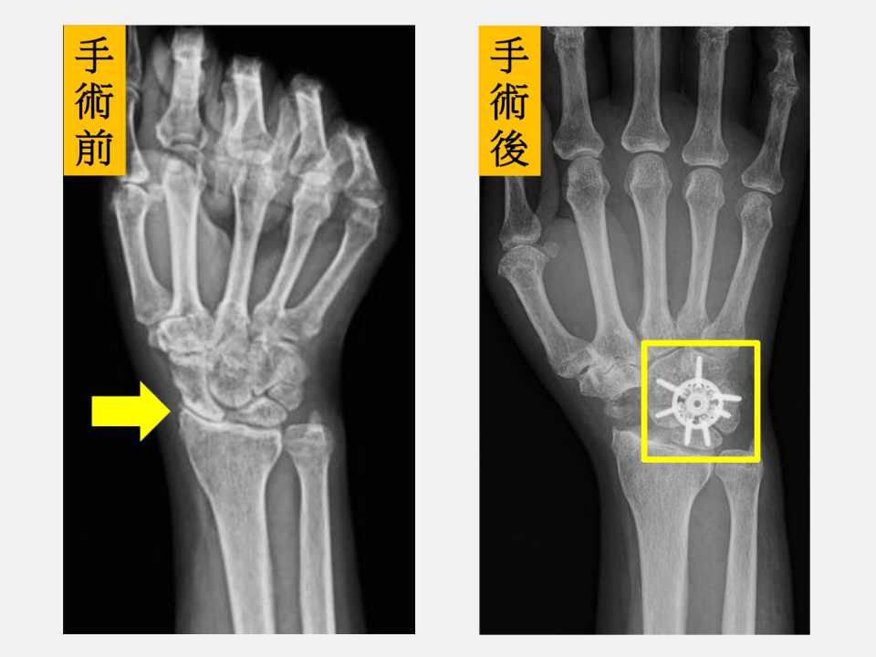 手腕退化莫輕忽 腕骨融合術助重拾生活品質-圖片2