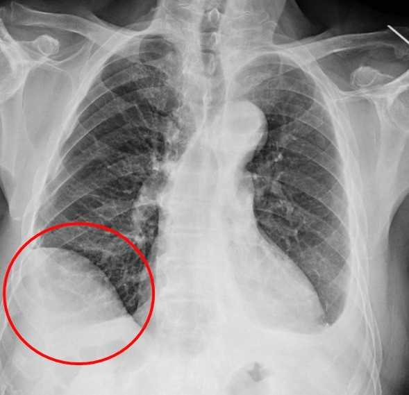 7旬罹癌男驚見肺腫瘤手術高難度 達文西助攻切除肺節-圖片2