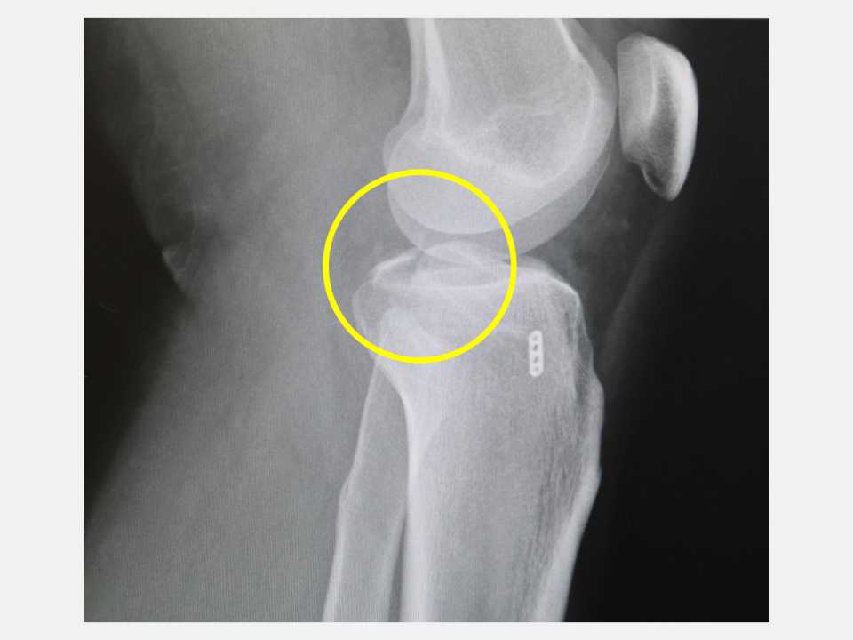 左膝後十字韌帶撕脫性骨折恐關節退化 微創手術助2個月後復原-圖片2